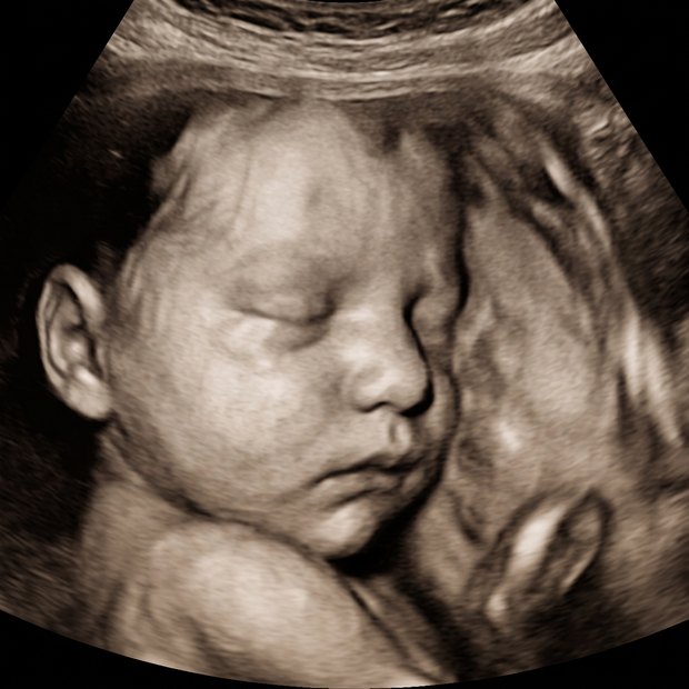 A 3D prenatal ultrasound of a sleeping baby